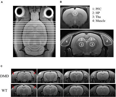 Abnormalities in Brain and Muscle Microstructure and Neurochemistry of the DMD Rat Measured by in vivo Diffusion Tensor Imaging and High Resolution Localized 1H MRS